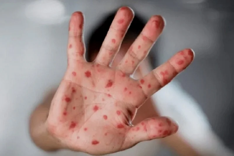Moroccan boy diagnosed with mpox in Ceuta, receiving treatment in isolation