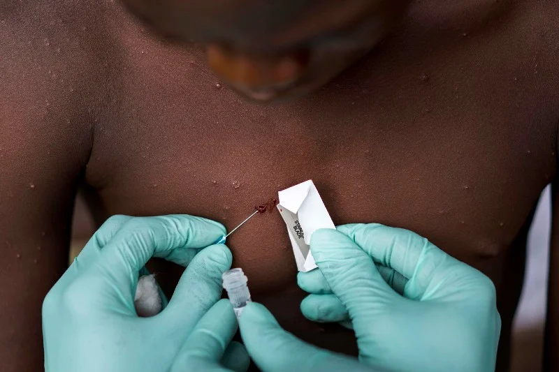 UAE reports first Monkeypox case