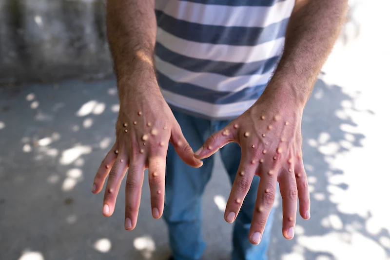 Europe warned to prepare for mpox as Pakistan reports first case