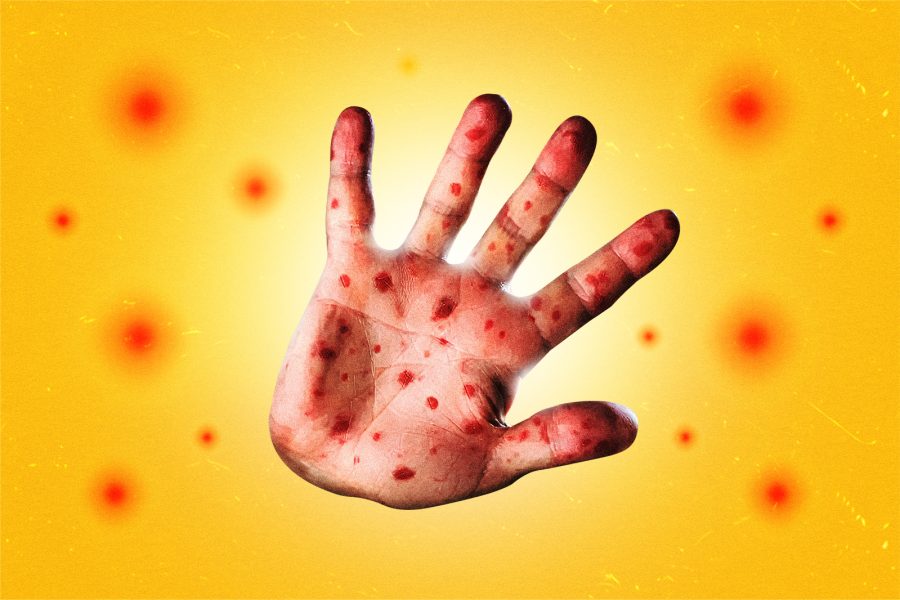 Morocco faces worst measles outbreak in decades—should we be concerned?